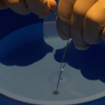 Imagen Unidad Neurovascular Innova en el tratamiento de aneurismas