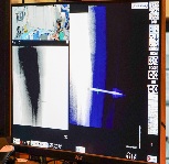 Imagen Con taladro queman tumores durante ablaciones óseas