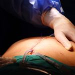 Imagen Primera cirugía HIPEC en el HGGB: